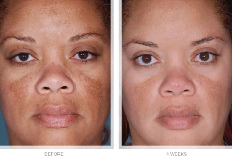 Whats The Role Of Arbutin In Treating Hyperpigmentation?